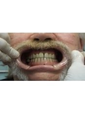 Porcelain Bridge - Bio Force Medical & Dental Clinic