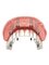 Maxillo Dental Clinic - All On 4 - Full Arch of Implant Retained Teeth - From €5,500 