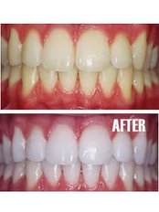 Teeth Whitening - Navan Dental