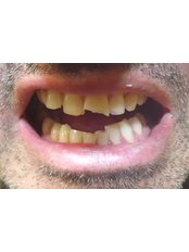 Clear Braces - G-Dental