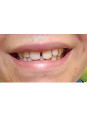 Six Month Smiles™ - G-Dental