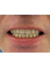 Dental Bridges - Bray Dental