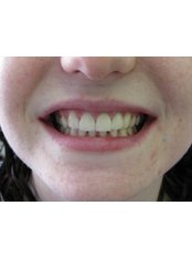 Veneers - Bray Dental
