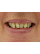 Dental Crowns - Bray Dental
