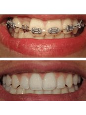 Orthodontics - ND Dental Esthetic & Implants- Implants Israel