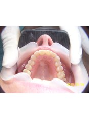 After INVISALIGN - Herzliya Dental Clinic