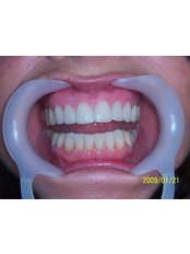 after veneers - Herzliya Dental Clinic