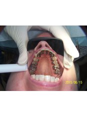 Lingual orthodontics - Herzliya Dental Clinic
