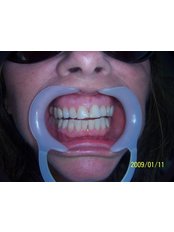 before veneers - Herzliya Dental Clinic
