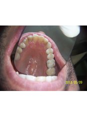 pocelain crowns and inlay -after - Herzliya Dental Clinic