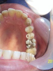 before porcelain crowns and inlay - Herzliya Dental Clinic