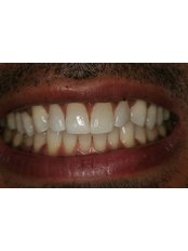 whitening after - Herzliya Dental Clinic