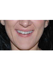 clear orthodontic bands - Herzliya Dental Clinic