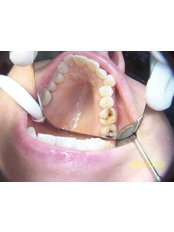 before INVISALIGN - Herzliya Dental Clinic