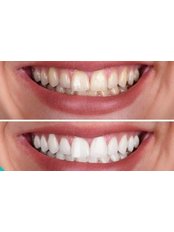 Teeth Whitening - sreter clinic