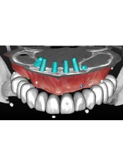 Dental Implants - Dr.Fabio Maltese