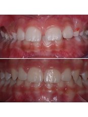 Invisible Orthodontics - Marano Dental Experience