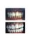 U-Smile Family Dental Practice - Bleaching before and after 