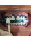 U-Smile Family Dental Practice - Bleaching  