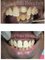 U-Smile Family Dental Practice - before and after ceramic crown 