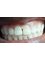 U-Smile Family Dental Practice - central incisor after bleaching 