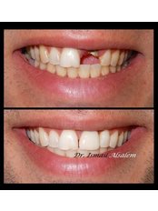 Dental Crowns - Alsalem Dental Clinics