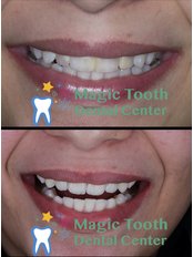 Dental Zirconia Crowns - Magic Tooth Dental Center