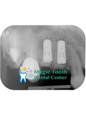 Dental Implants - Magic Tooth Dental Center
