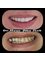 Nour Abu Rub Dental Clinic - Zircon crowns and bridge done for a female patient done by Dr.Nour Abu Rub 