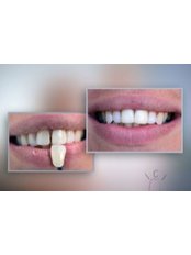 Porcelain Veneers - Privat Dental Clinic ComfortDent