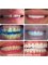 Dental Clinic Lebanon Beirut - Hollywood smile Lebanon by Dental clinic Lebanon ISO 9001 