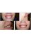 Ferrari Dental Clinic Beirut Lebanon - gummy-smile-Lebanon-Beirut-correction-Laser-dentistry 