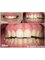 Ferrari Dental Clinic Beirut Lebanon - gummy-smile-Lebanon-Beirut-correction-Laser-dentistry 