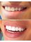 Hollywood Smile Dekwaneh - hollywood smile beirut lebanon dental clinic dentist 