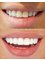 Hollywood Smile Dekwaneh - hollywood_smile_lebanon_beirut_style_dental_clinic_ 