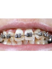Metal Braces - Khoury Dental Clinic: Lebanon - Beirut
