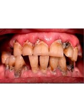 Restorative Dentist Consultation - Prosmile Clinic Lebanon