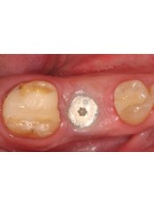 Implant Dentist Consultation - Prosmile Clinic Lebanon