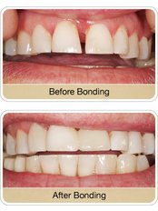 Dental Bonding - Dr.Mohamed