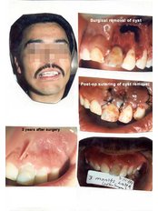Treatment of Dental Abscess - Dr.Mohamed
