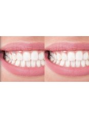 Metal-Free Implants, ceramic Swiss Dental Solutions (SDS) - Auksteja, UAB