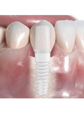 Immediate Implant Placement, ceramic Swiss Dental Solutions (SDS) - Auksteja, UAB