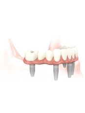 Dental Implants - Dantų harmonija - Dental Harmony