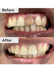 Dental Crowns - Koosh Dental