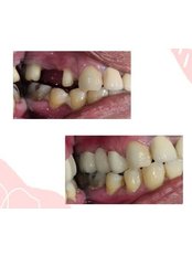 Dental Bridges - Koosh Dental