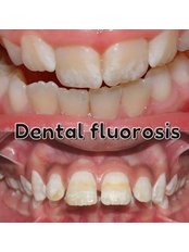 Fluoride Therapy - Koosh Dental