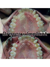 Braces - Koosh Dental