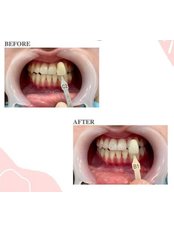 Teeth Whitening - Koosh Dental