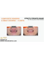 Composite Veneers - Beverly Wilshire Dental Kuala Lumpur