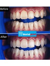 Teeth Whitening - Dentalpoint Kepong